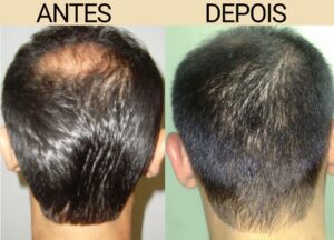 Leia mais sobre o artigo Hair Therapy: Combate à Queda Capilar e Fortalecimento